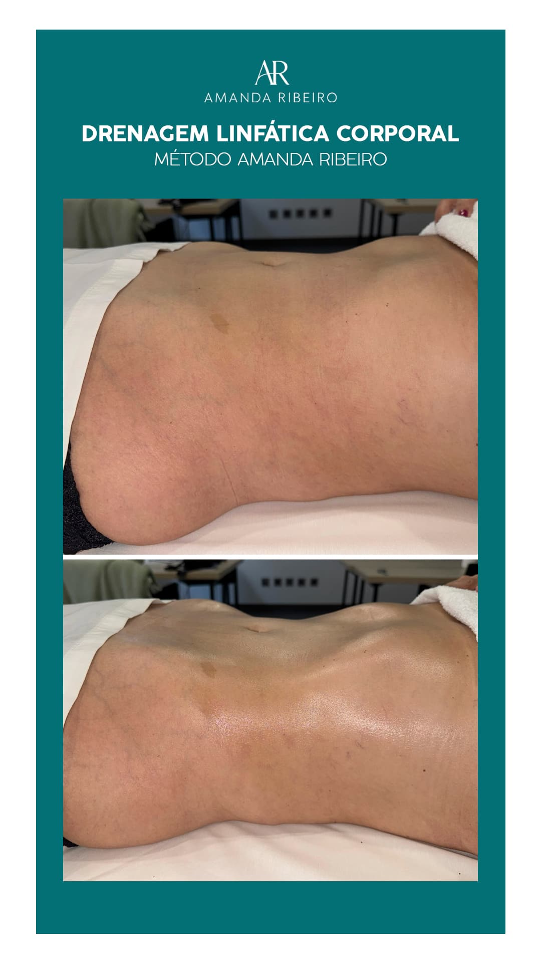 Resultado antes e depois - Drenagem Linfática