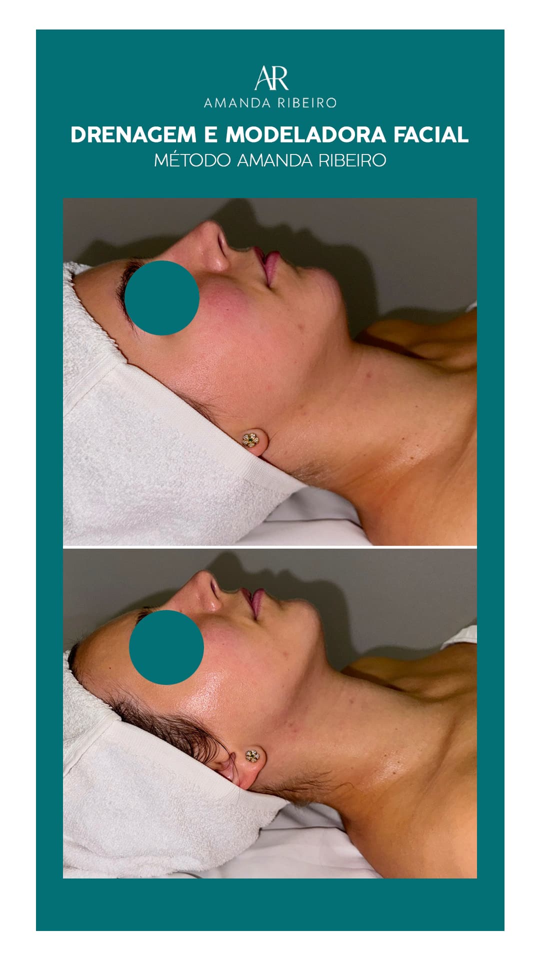 Resultado antes e depois - Drenagem Facial