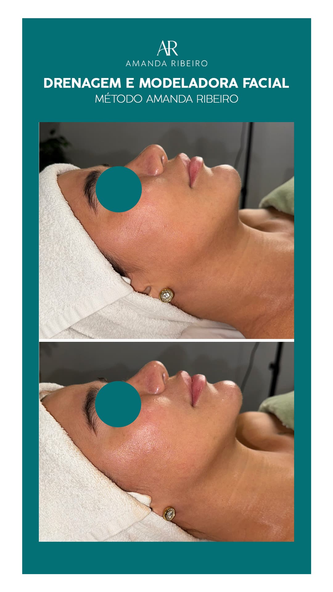 Resultado antes e depois - Drenagem Facial