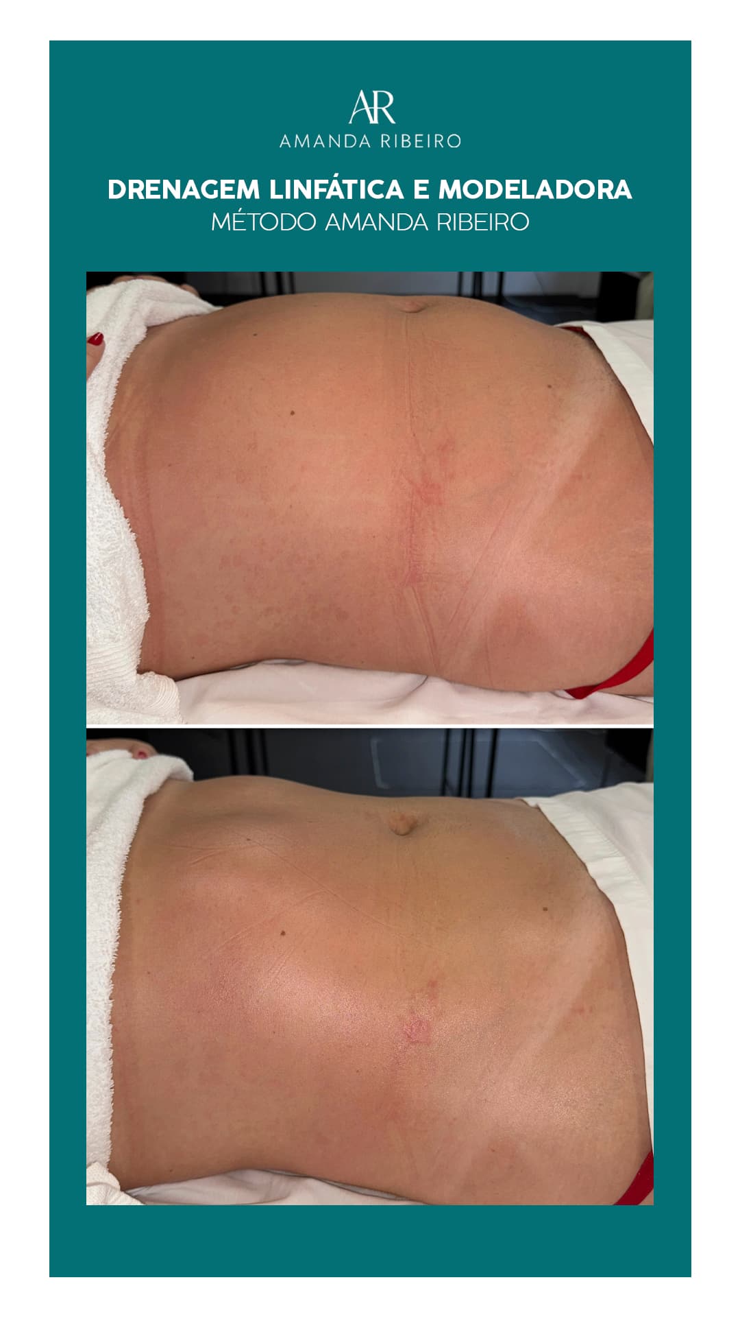 Resultado antes e depois - Drenagem Modeladora